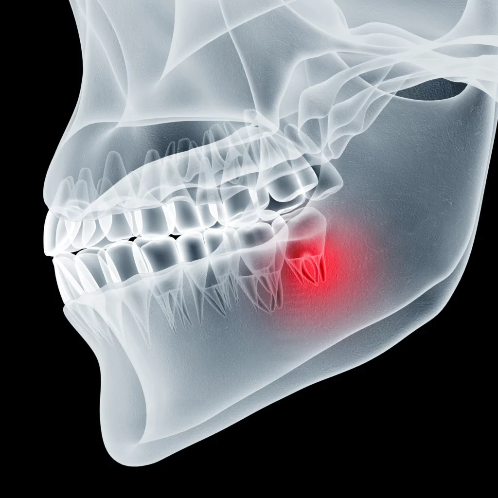 wisdom teeth removal in Mt Juliet, TN