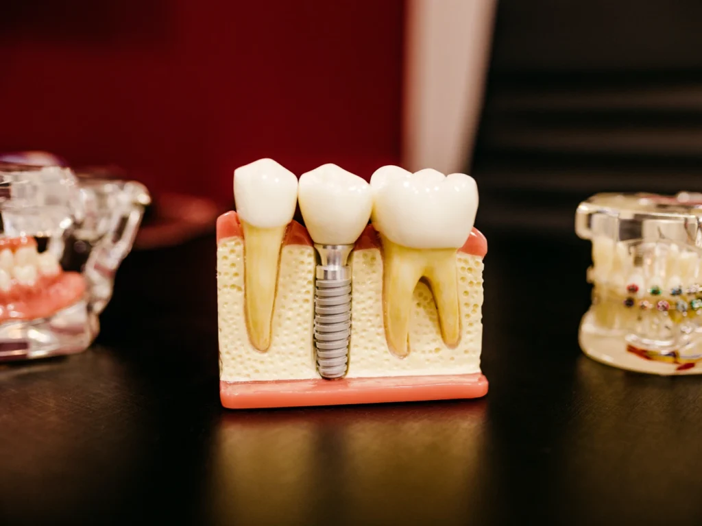 model of a single tooth dental implant | cost of dental implants in Mt Juliet, TN