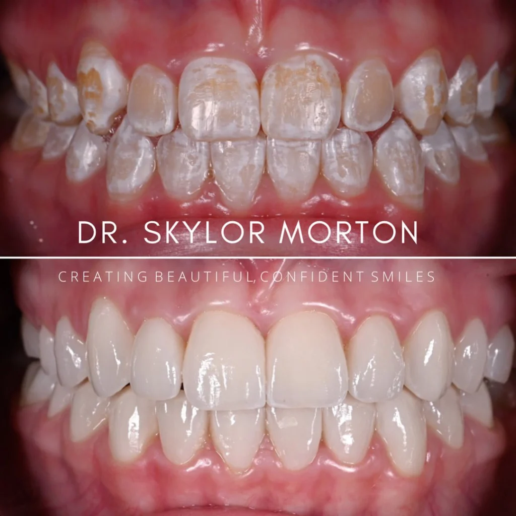 Before and after a smile makeover in Tennessee at Mt Juliet Dental Studio by Dr. Skylor Morton