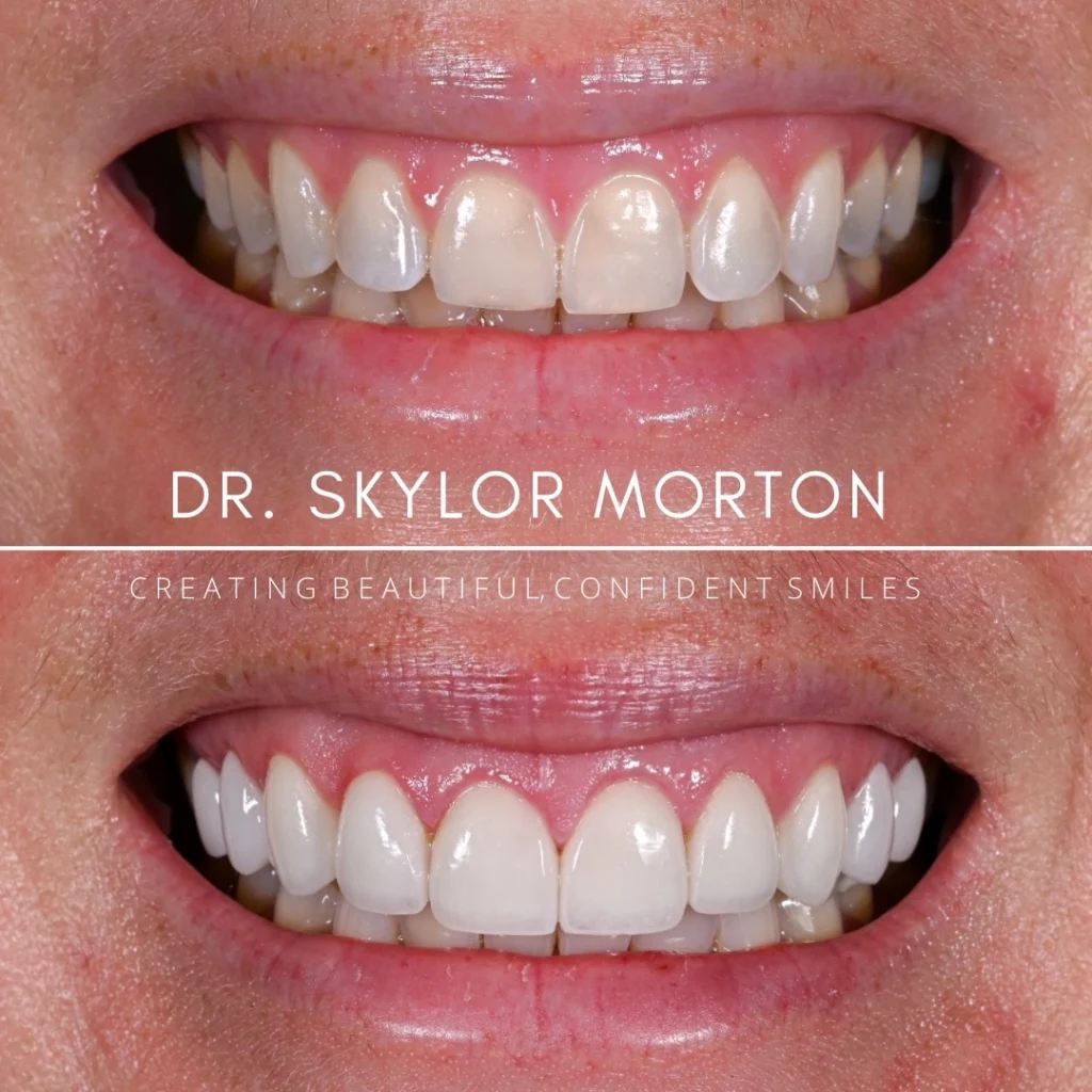 Before and after a smile makeover in Tennessee at Mt Juliet Dental Studio by Dr. Skylor Morton