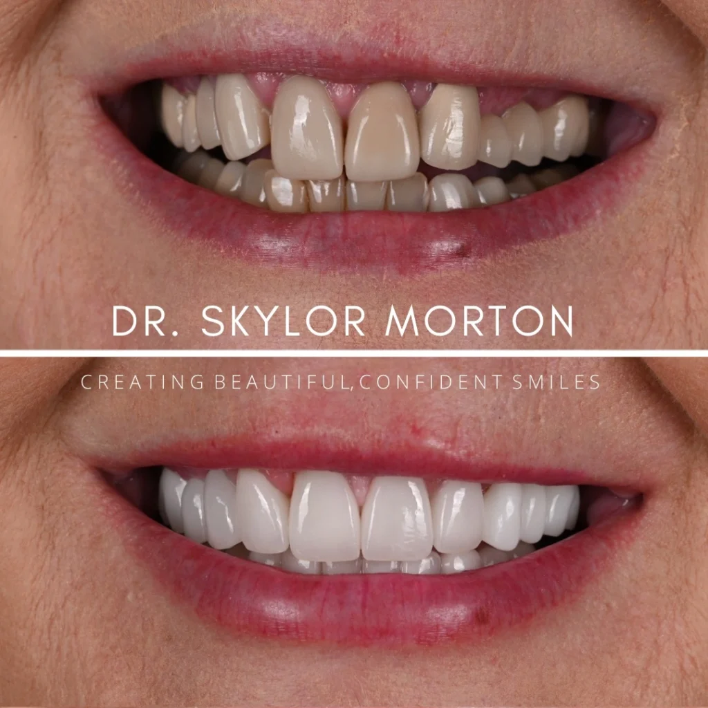 Before and after a smile makeover in Tennessee at Mt Juliet Dental Studio by Dr. Skylor Morton