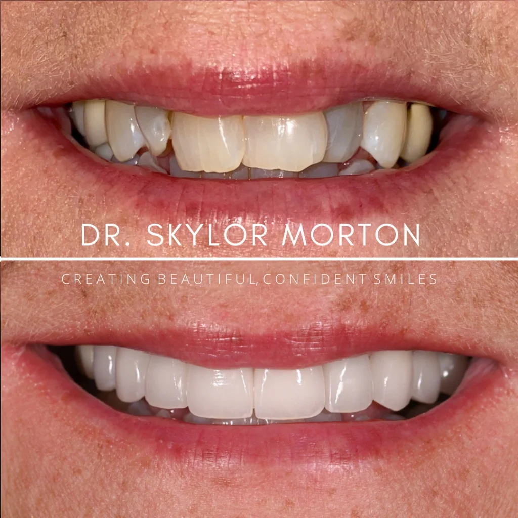 Before and after a smile makeover in Tennessee at Mt Juliet Dental Studio by Dr. Skylor Morton