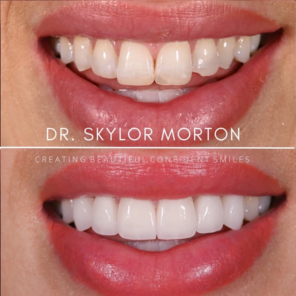 Before and after a smile makeover in Tennessee at Mt Juliet Dental Studio by Dr. Skylor Morton