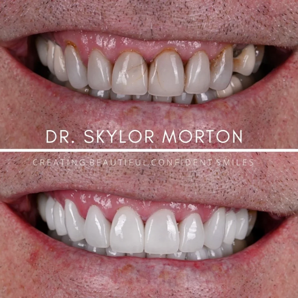Before and after a smile makeover in Tennessee at Mt Juliet Dental Studio by Dr. Skylor Morton
