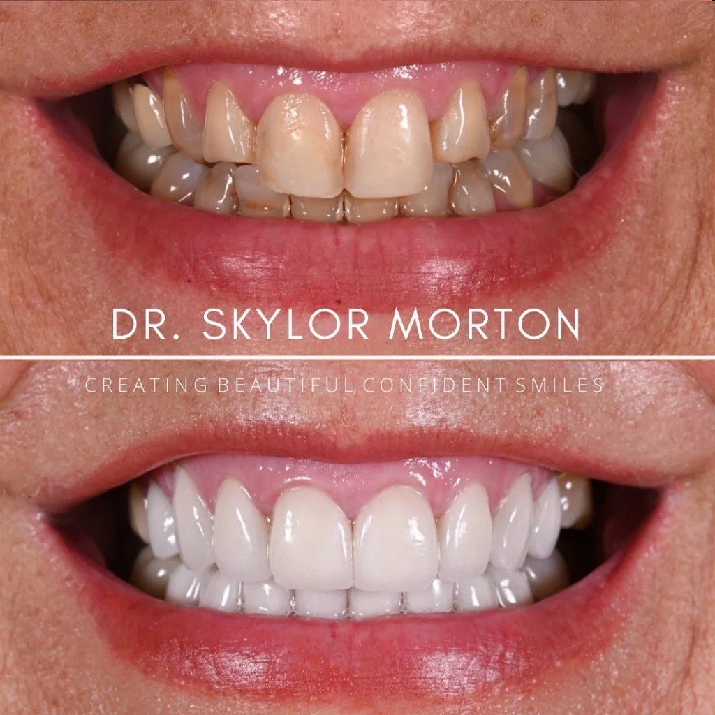 Before and after a smile makeover in Tennessee at Mt Juliet Dental Studio by Dr. Skylor Morton