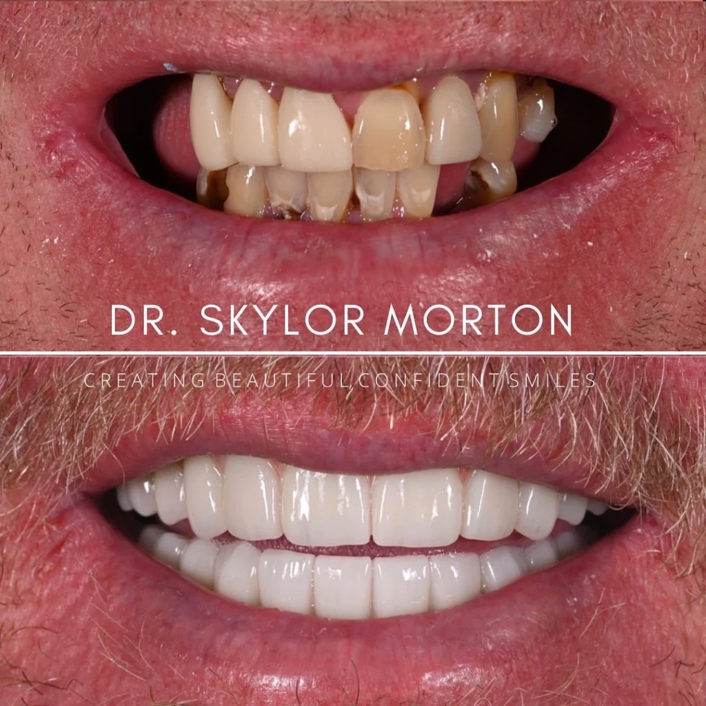 Before and after a smile makeover in Tennessee at Mt Juliet Dental Studio by Dr. Skylor Morton