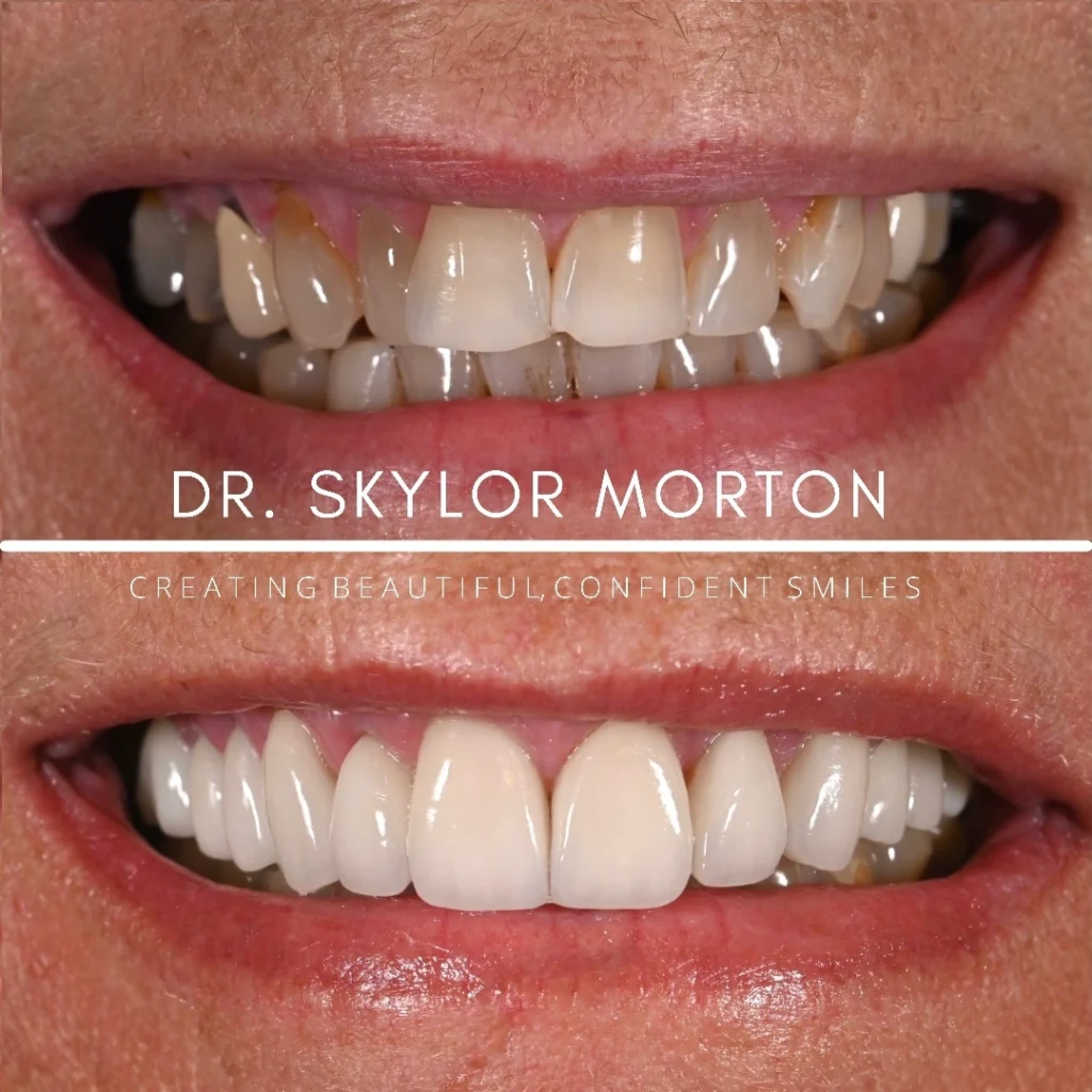 Before and after a smile makeover in Tennessee at Mt Juliet Dental Studio by Dr. Skylor Morton