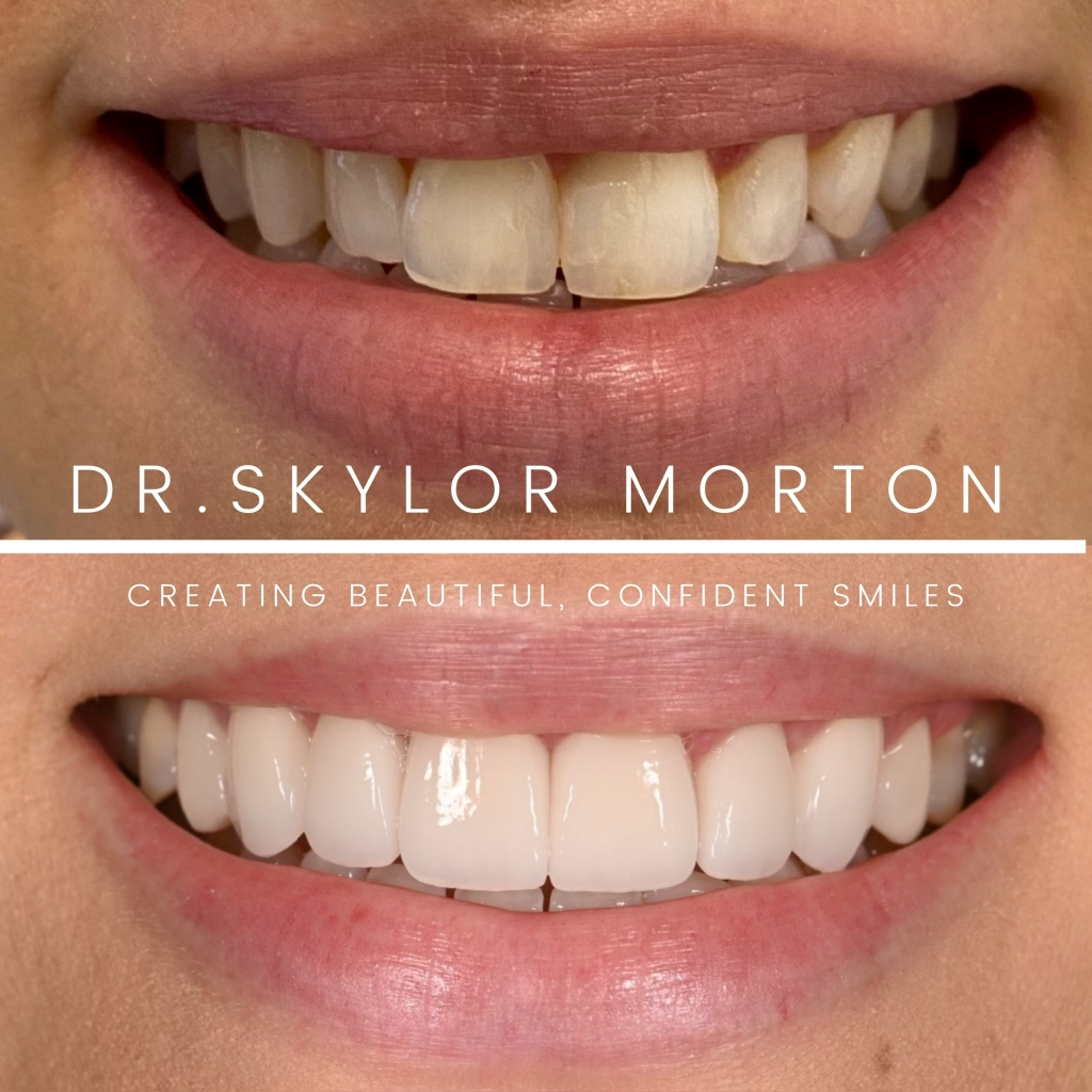 Before and after a smile makeover in Tennessee at Mt Juliet Dental Studio by Dr. Skylor Morton
