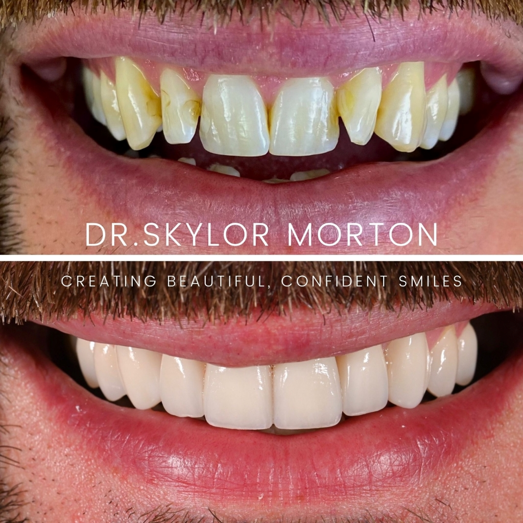 Before and after a smile makeover in Tennessee at Mt Juliet Dental Studio by Dr. Skylor Morton