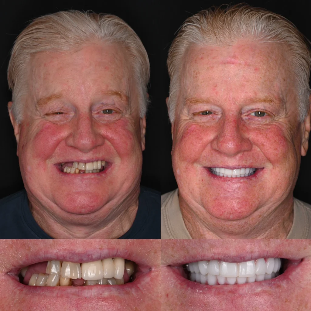 Before and after dental implants in Mt Juliet, TN at Mt Juliet Dental Studio