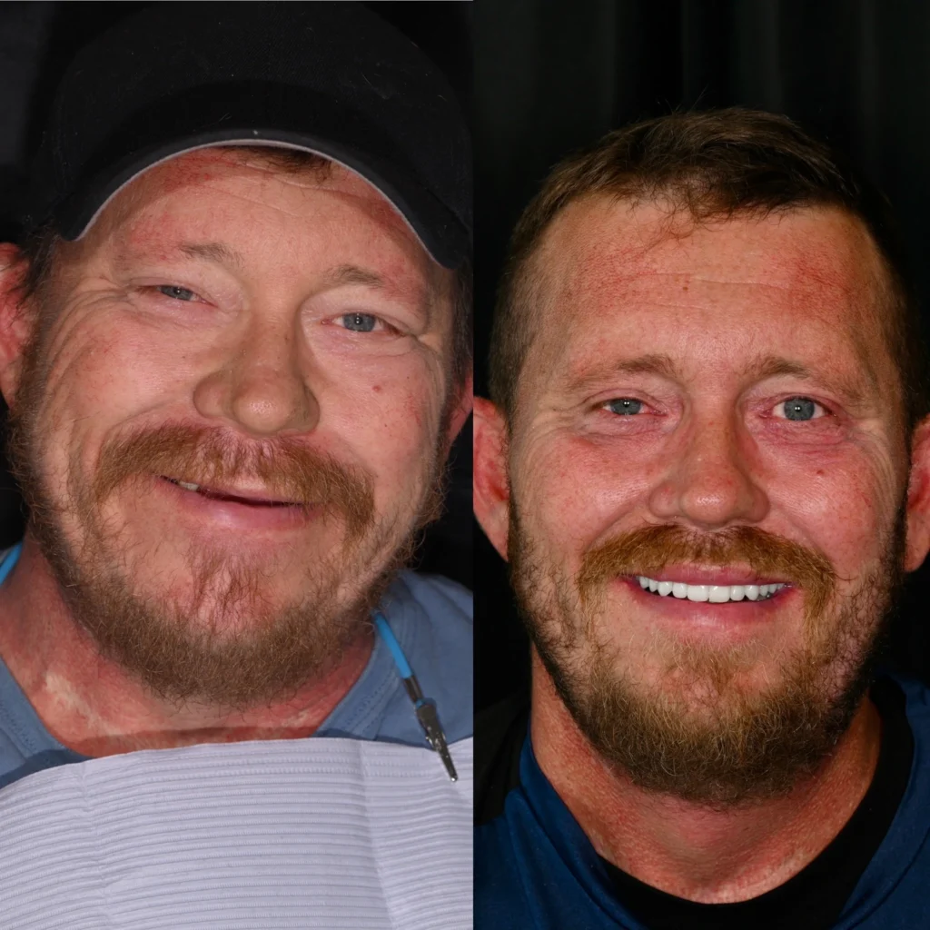 Before and after dental implants in Mt Juliet, TN at Mt Juliet Dental Studio