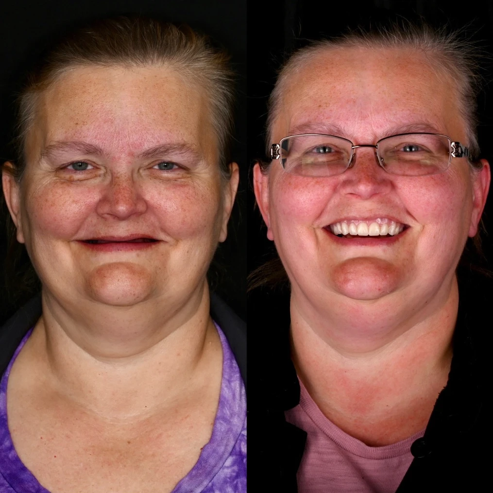 Before and after dental implants in Mt Juliet, TN at Mt Juliet Dental Studio