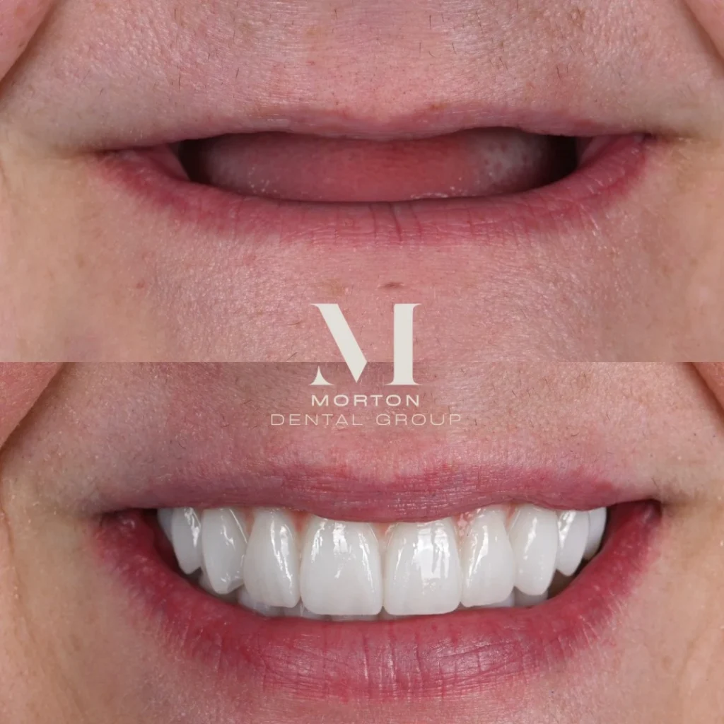 Before and after dental implants in Mt Juliet, TN at Mt Juliet Dental Studio