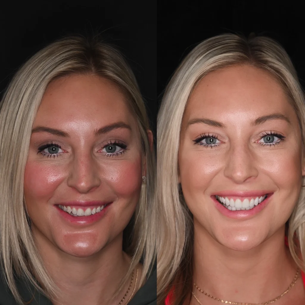 Before and after a smile makeover in Tennessee at Mt Juliet Dental Studio by Dr. Skylor Morton