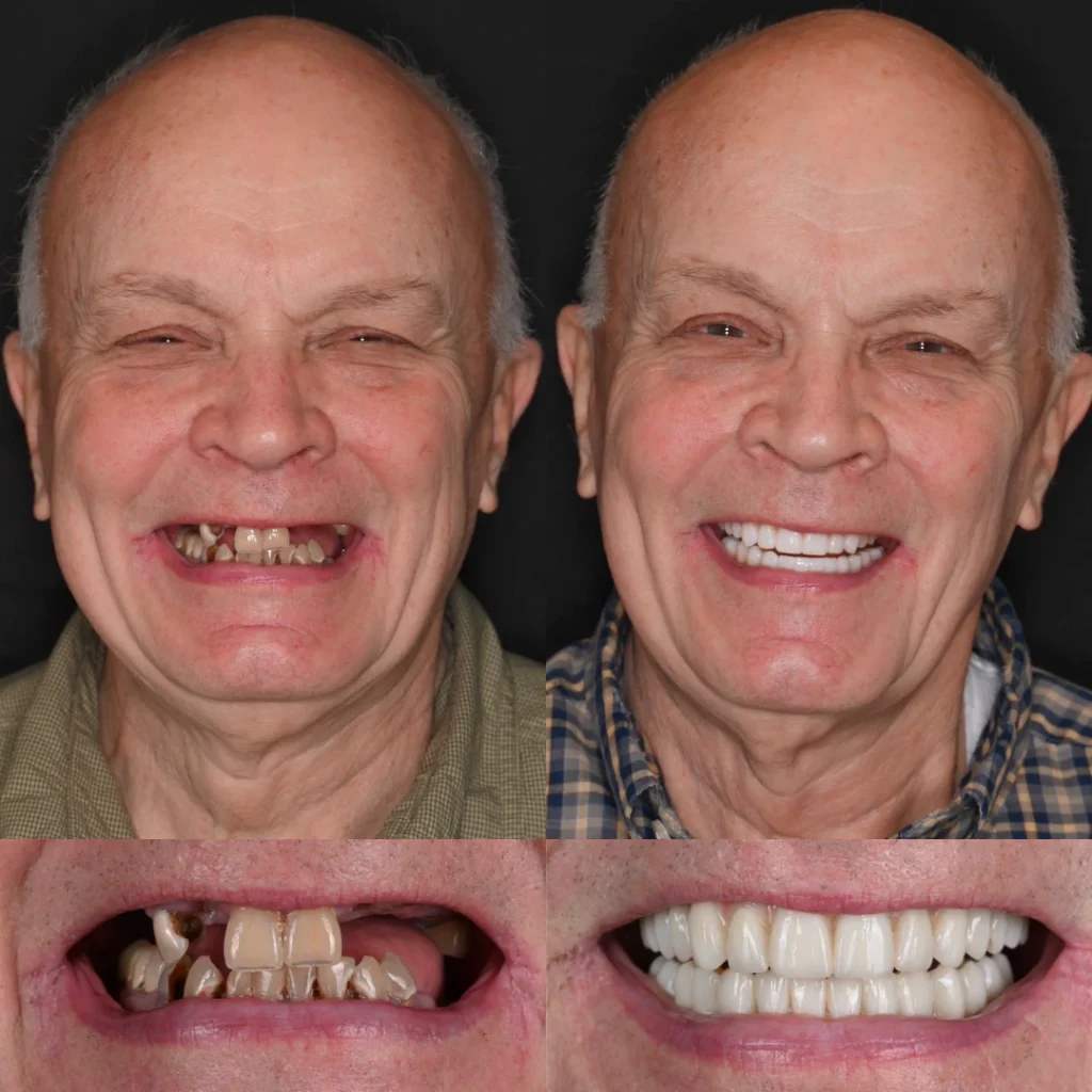 Before and after dental implants in Mt Juliet, TN at Mt Juliet Dental Studio