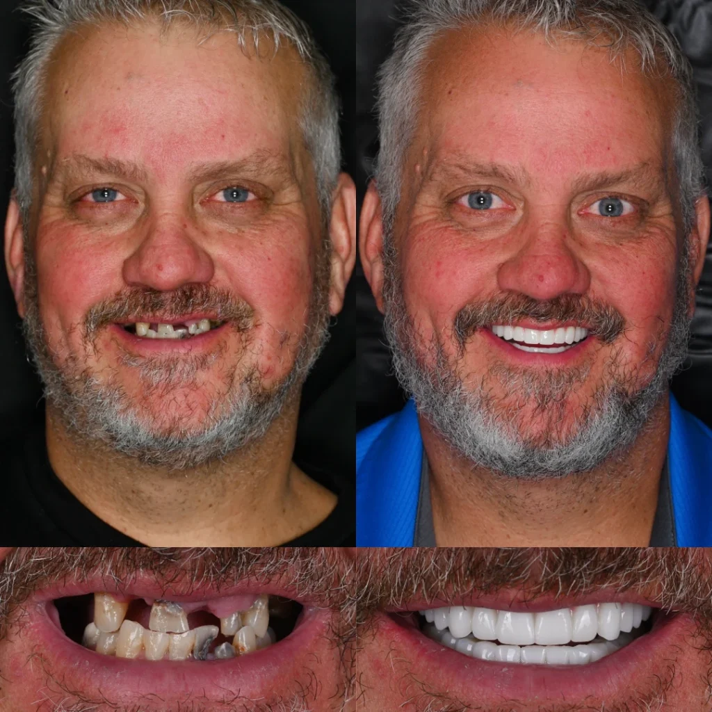 Before and after dental implants in Mt Juliet, TN at Mt Juliet Dental Studio