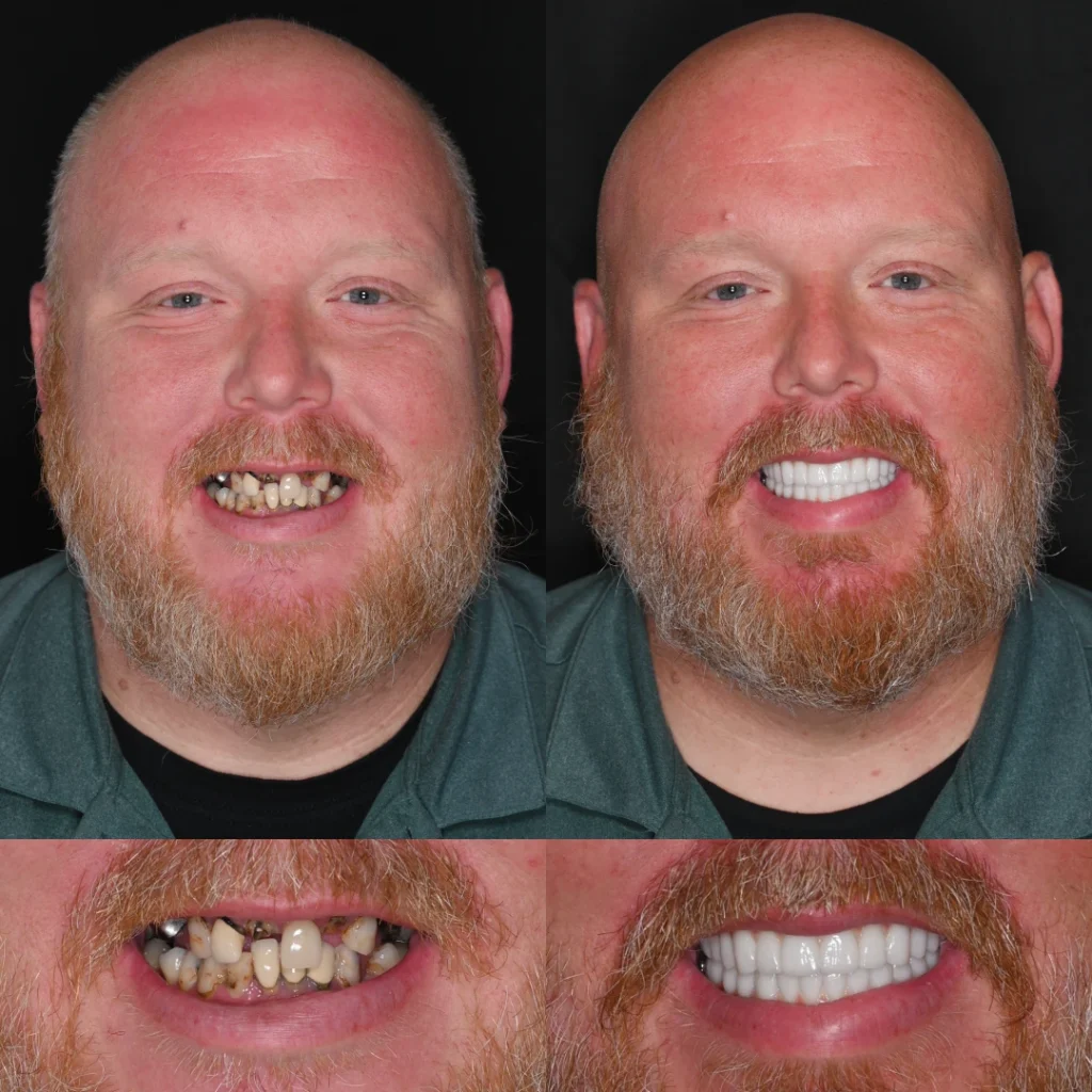 Before and after dental implants in Mt Juliet, TN at Mt Juliet Dental Studio