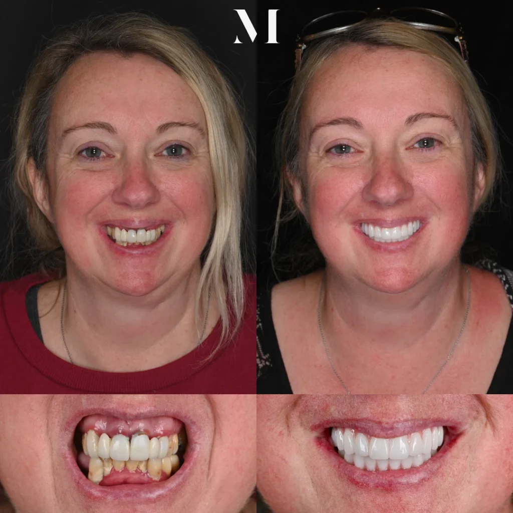 Before and after dental implants in Mt Juliet, TN at Mt Juliet Dental Studio